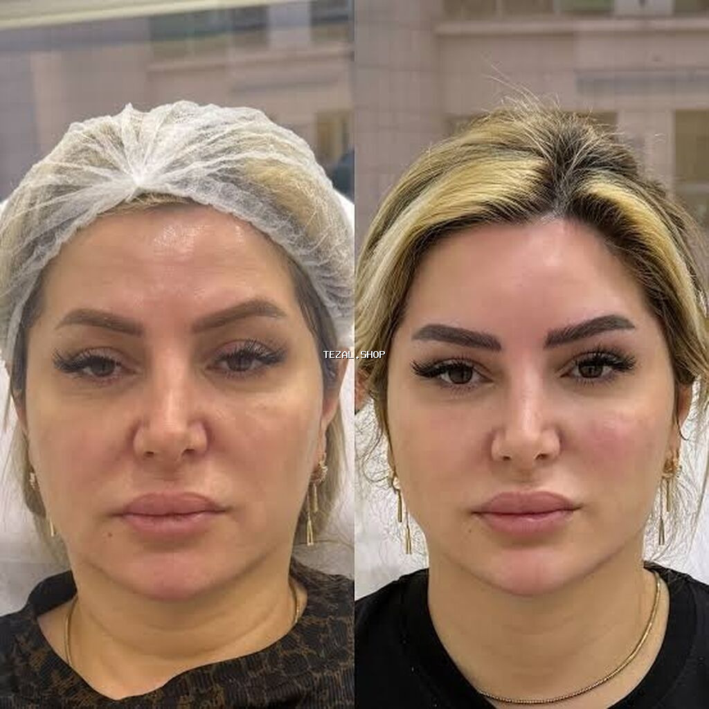 Son model lazer cihazla - Dərinin sıxlığının artırılması, incə