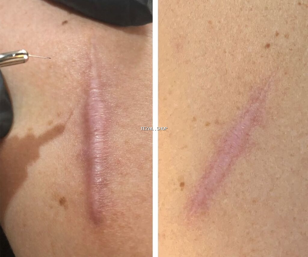 Yara izi korreksiyası xidməti - Fraksional mikroiynə və aparat