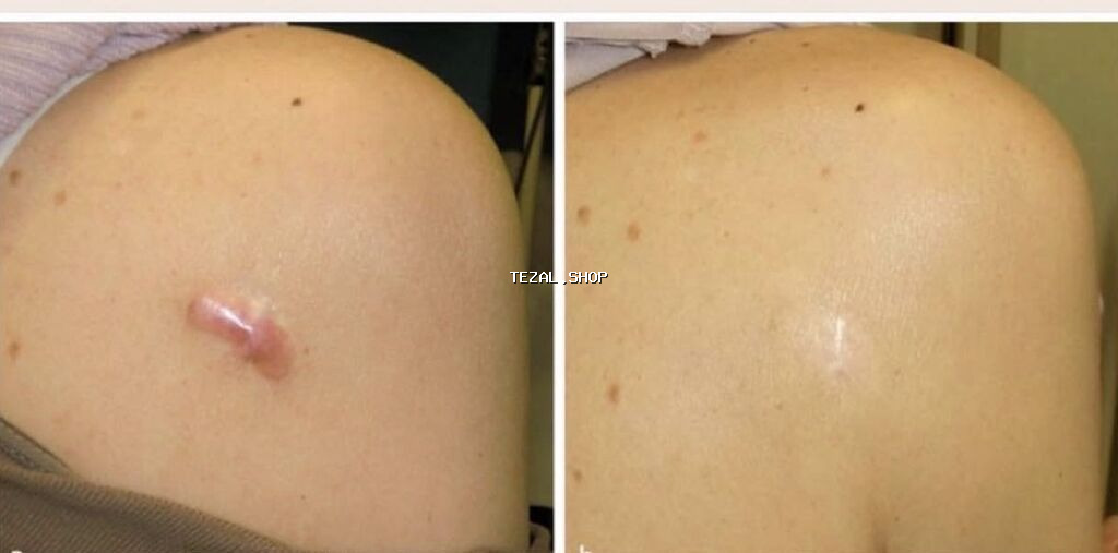 Yara izi korreksiyası xidməti - Fraksional mikroiynə və aparat - şəkil 2