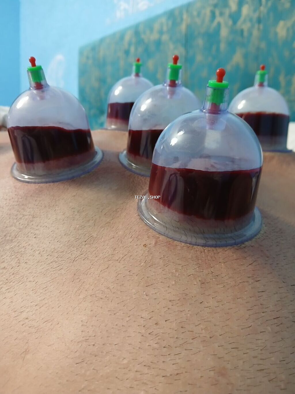 Hicama (qan çıxarma) xidməti - Steril, birdəfəlik vakuum bankalar və