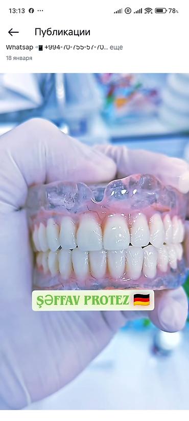 İndi Daha Rahat və Estetik 💠 Qiymətlər Estetik plomb (1 diş) – 50₼ - şəkil 3