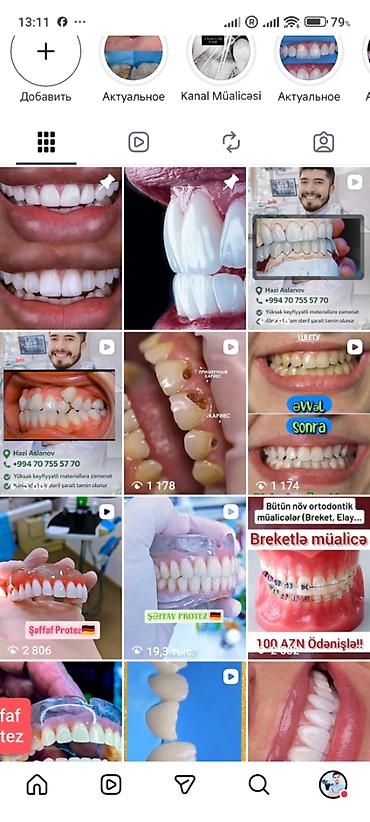 İndi Daha Rahat və Estetik 💠 Qiymətlər Estetik plomb (1 diş) – 50₼ - şəkil 2