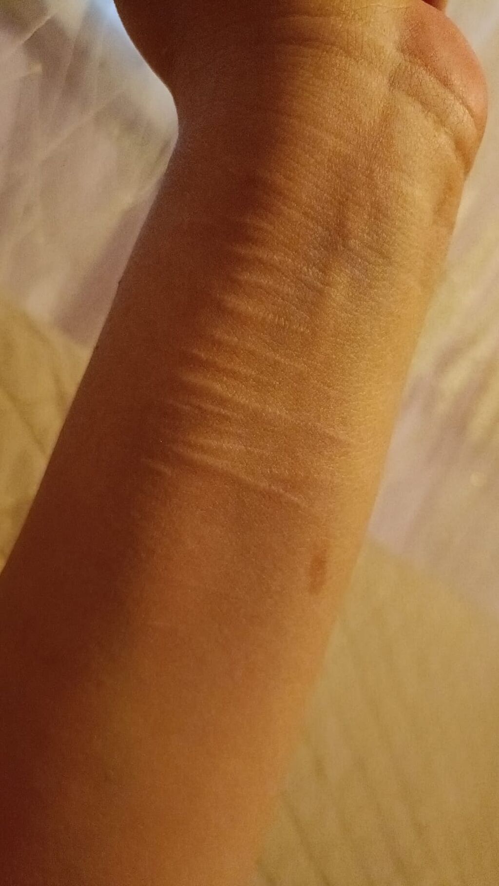 Çapıqların lazer vasitəsilə yox edilməsi