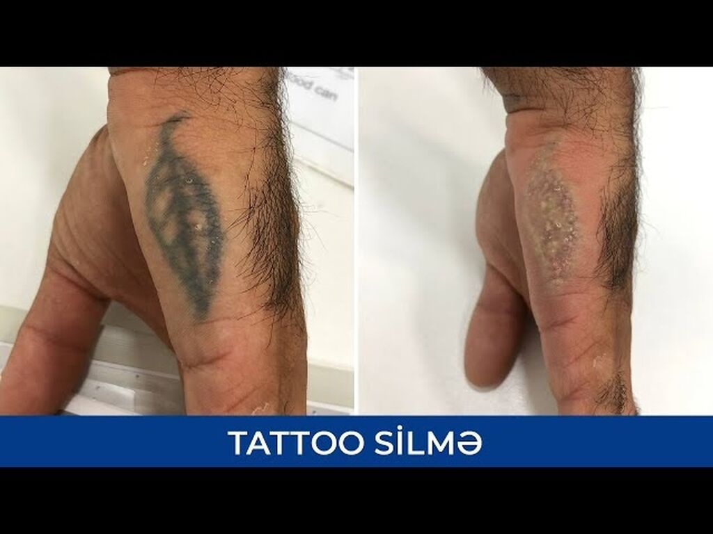 Xidmət: Tattoo silmə Təsvir: - Professional lazer texnologiyası ilə