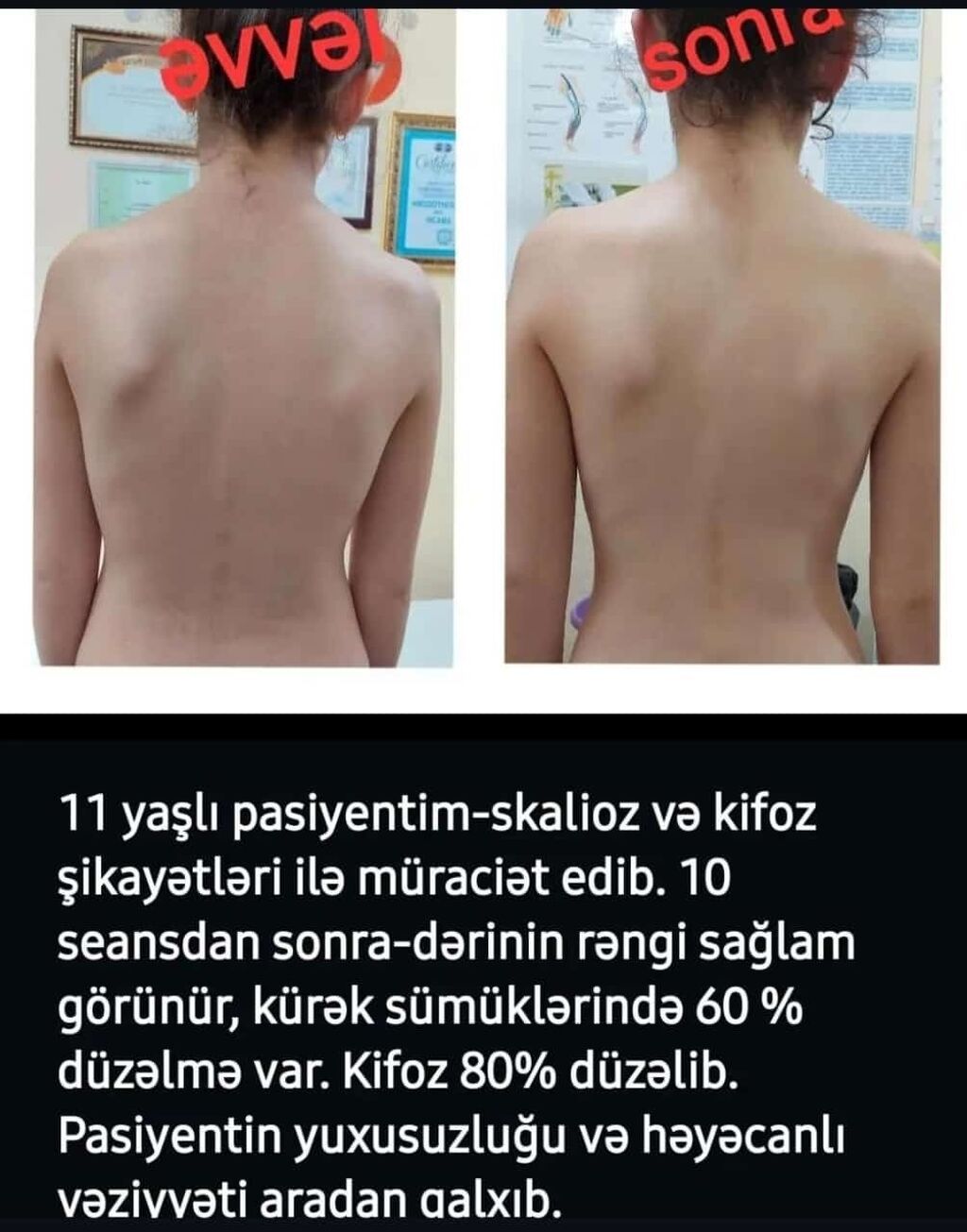 Skolioz masajı, Uşaqlar üçün