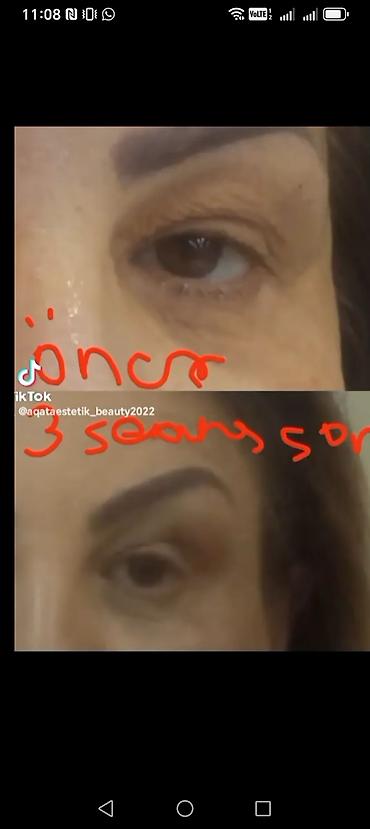 Estetik xidmətlər: üz və bədən üçün qeyri‑invaziv kontur formalaşdırma - şəkil 2