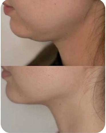 Estetik xidmətlər: üz və bədən üçün qeyri‑invaziv kontur formalaşdırma - şəkil 3