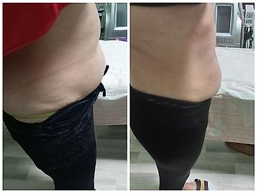 Estetik xidmətlər: üz və bədən üçün qeyri‑invaziv kontur formalaşdırma - şəkil 4