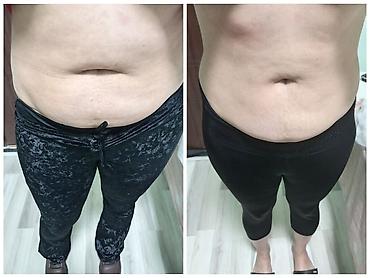 Estetik xidmətlər: üz və bədən üçün qeyri‑invaziv kontur formalaşdırma - şəkil 5